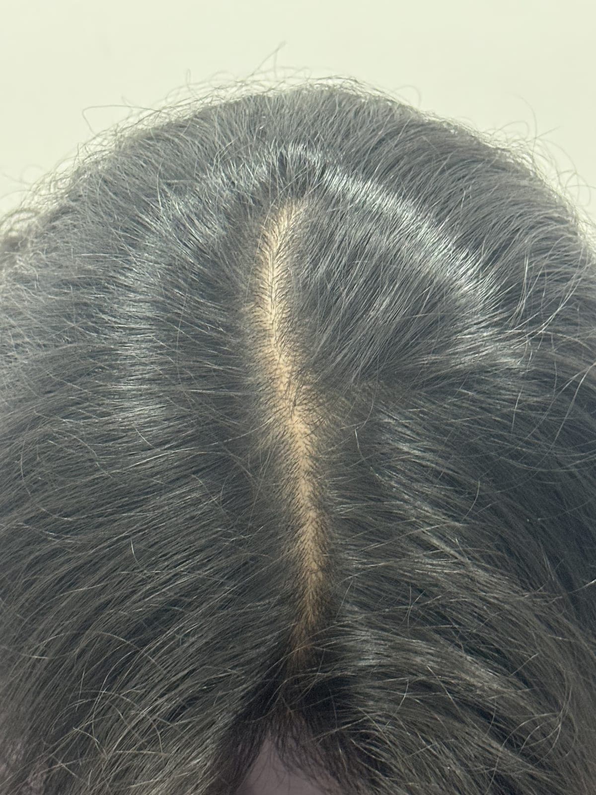 PRP Hair Treatment after